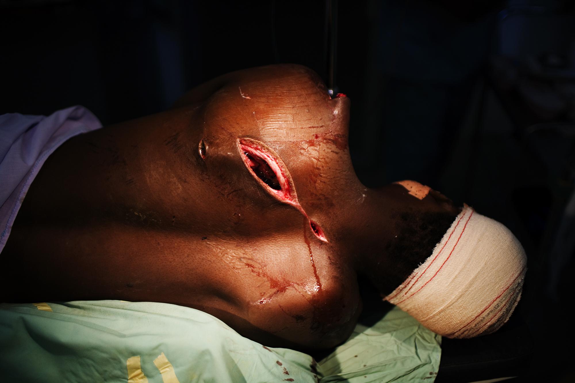 Haiti for MSF - HAITI Cite Soleil, Port-au-Prince
A wounded man is...