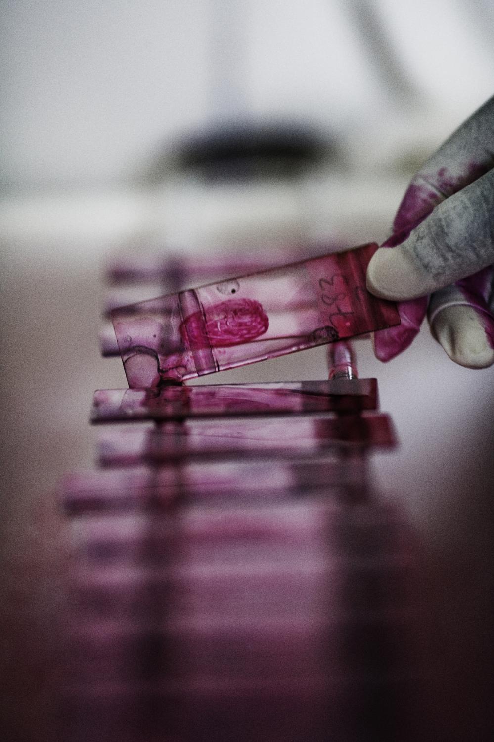 Tuberculosis / Lesotho - Lesotho.
A nurse is working with sputum samples that are...
