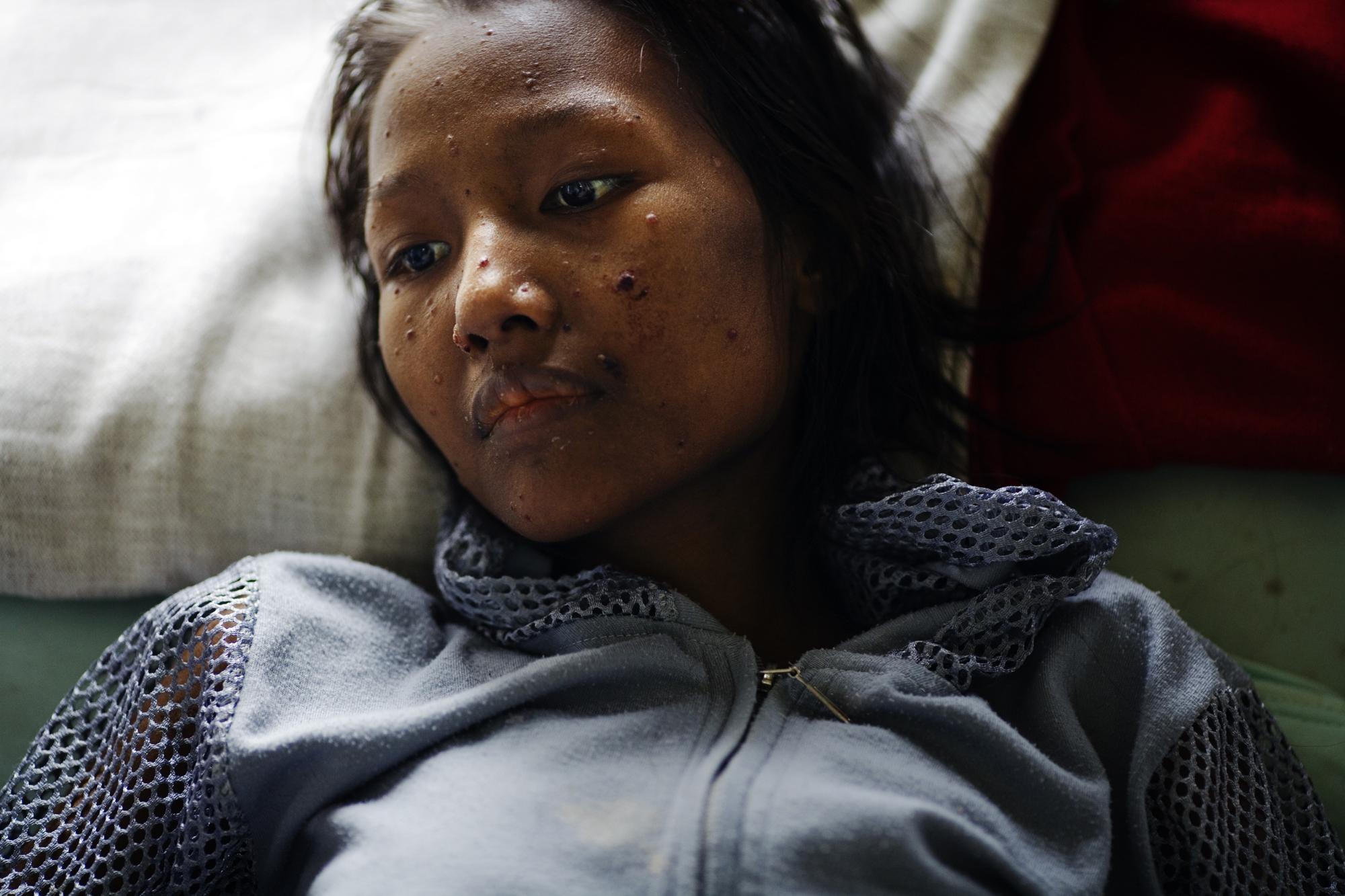 Injecting death - INDIA Aizawl, Mizoram A young AIDS patient at the Grace...