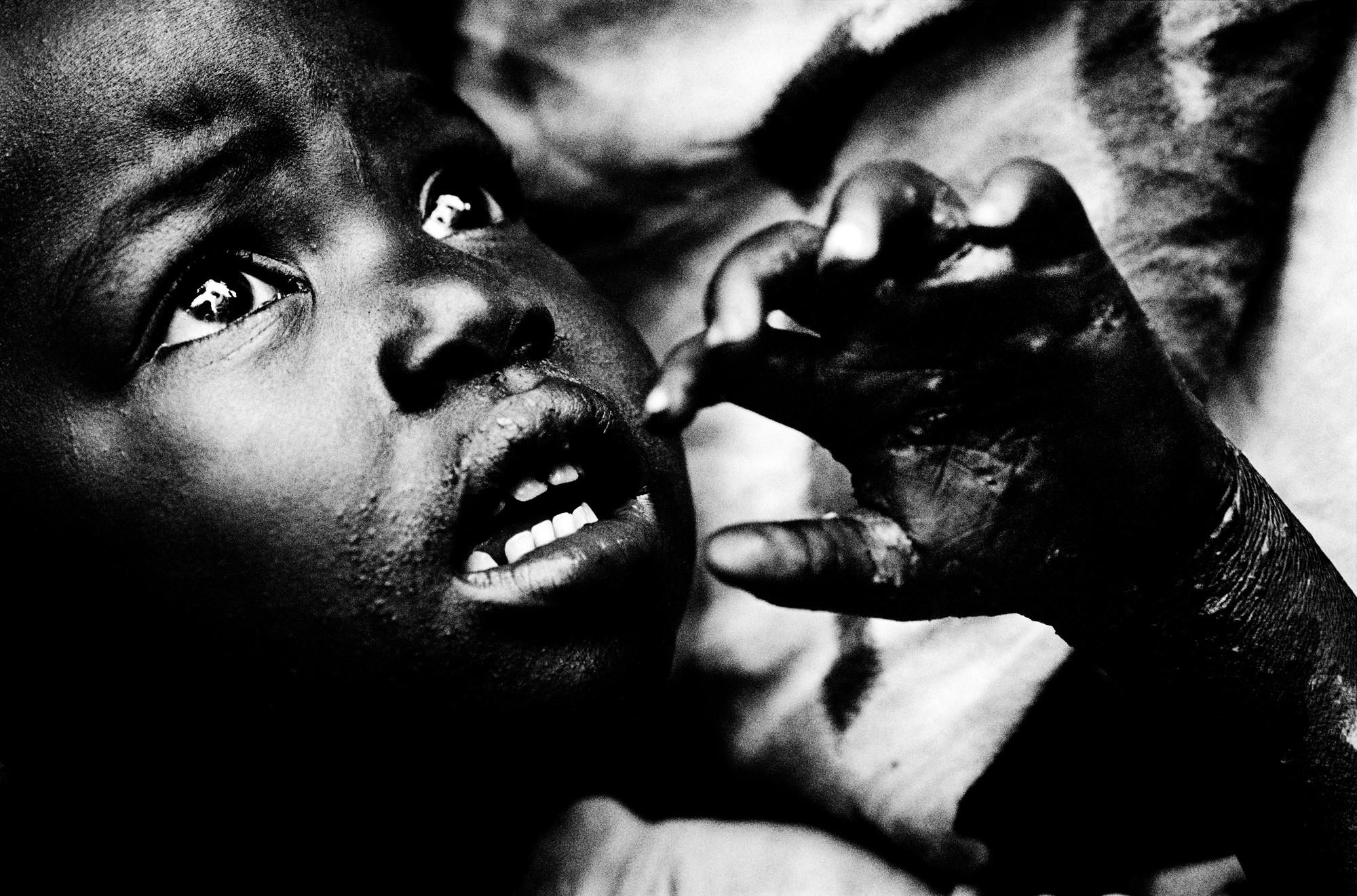 Somalia, the invisible trace - SOMALIA Jowhar A child with a skin infection at the...