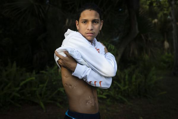 Marjory Stoneman Douglas High School shooting survivor Anthony Borges shows his injuries during an interview with AFP in Coral Springs, Florida, on August 9, 2019. The scourge of gun violence in the US is no secret: some 36,000 Americans are killed every year on average, or about 100 a day, in homicides, suicides, police-involved shootings and accidents. Hundreds more are shot and wounded daily in the most-heavily armed country in the world. Those victims -- of mass shootings, or just everyday arguments that go awry -- live on with their wounds. Eva Marie UZCATEGUI / AFP