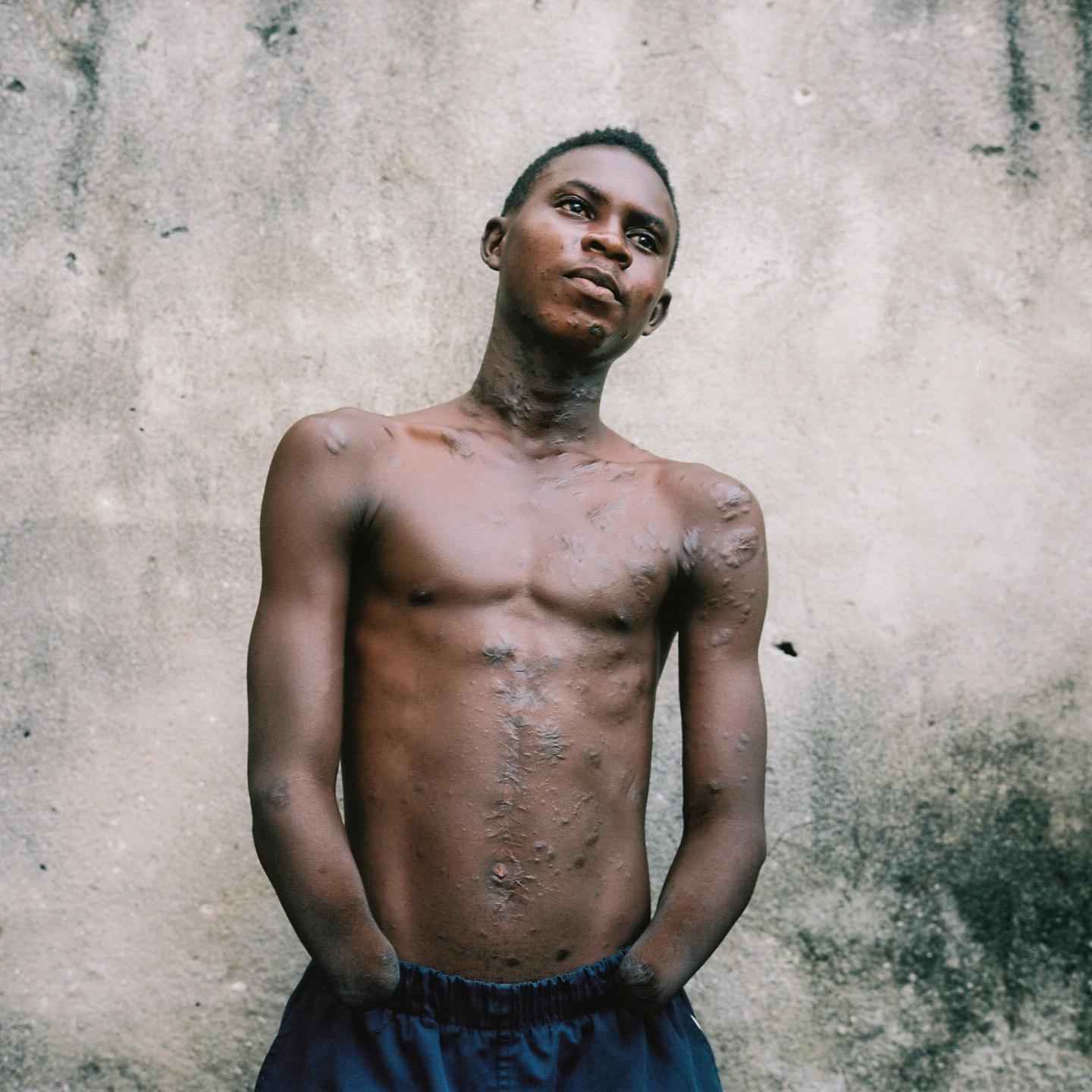 T&eacute;moin Yego Alphonse, 25 years old. Abidjan. Alphonse was 17 years old when he lost both his hands to a granade explosion. He was...