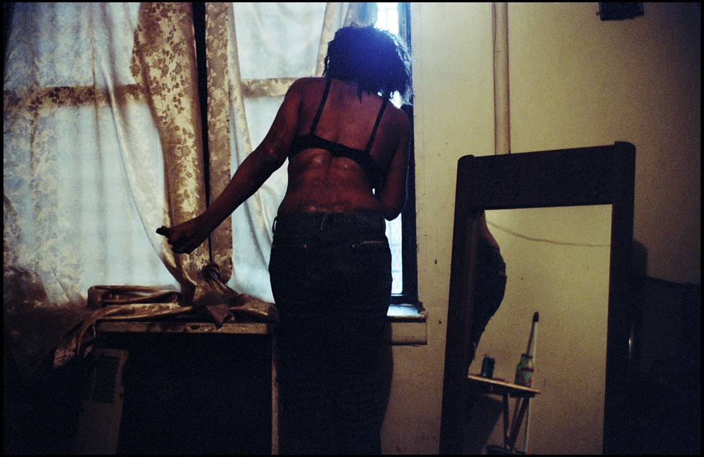  Nina looking out the window of her apartment. The scars on her back are the result of third degree burns she suffered in an apartment fire when...