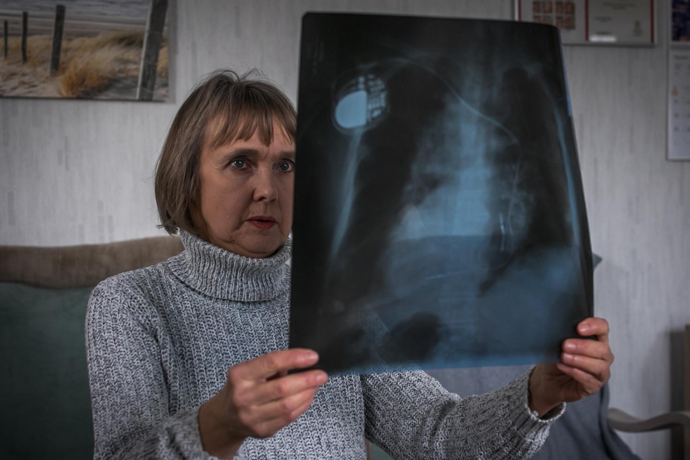 Aleksandr Bedek looks at an x-ray of her mother, who died of lung disease. Aleksandra also has health problems caused by smog in Krakow. 2021, Krak&oacute;w, Poland.