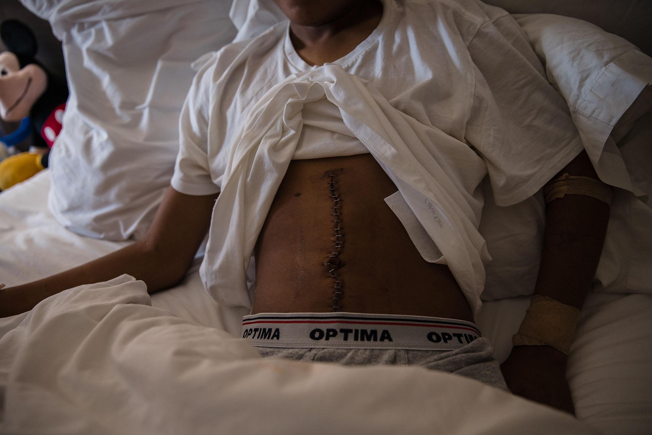 Jose Eduardo Martinez Gonzalez shows his stomach with surgical staples after being hospitalized.