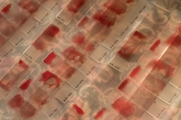 Blood smears | Buy this image