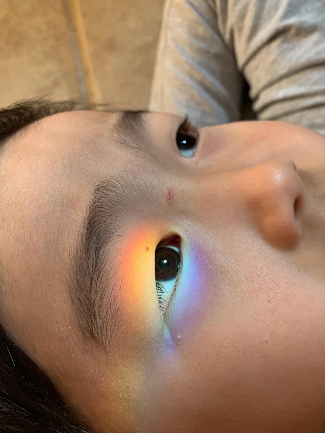Rainbow and sister&#39;s scratch on Teo&#39;s eye, 2020