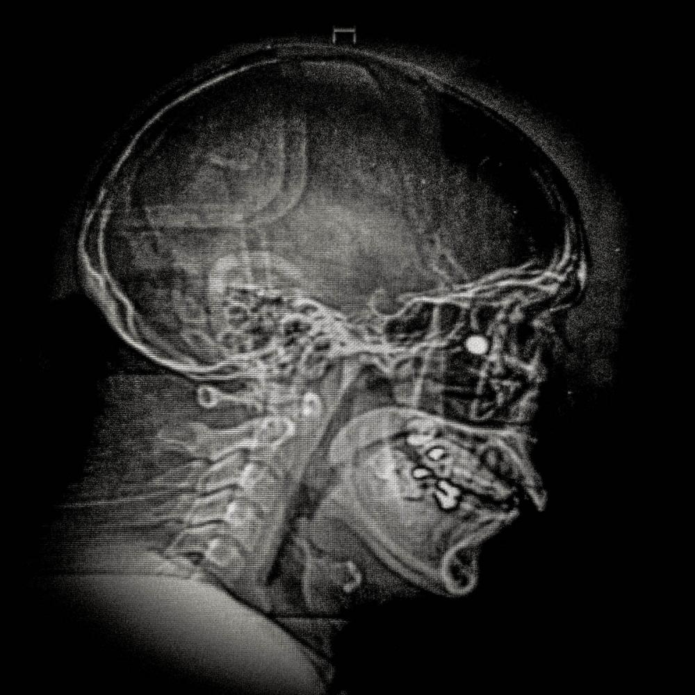 X-ray showing the pellet embedded in the skull of Ybar Soto (29) Electrical Technician. Lives in...