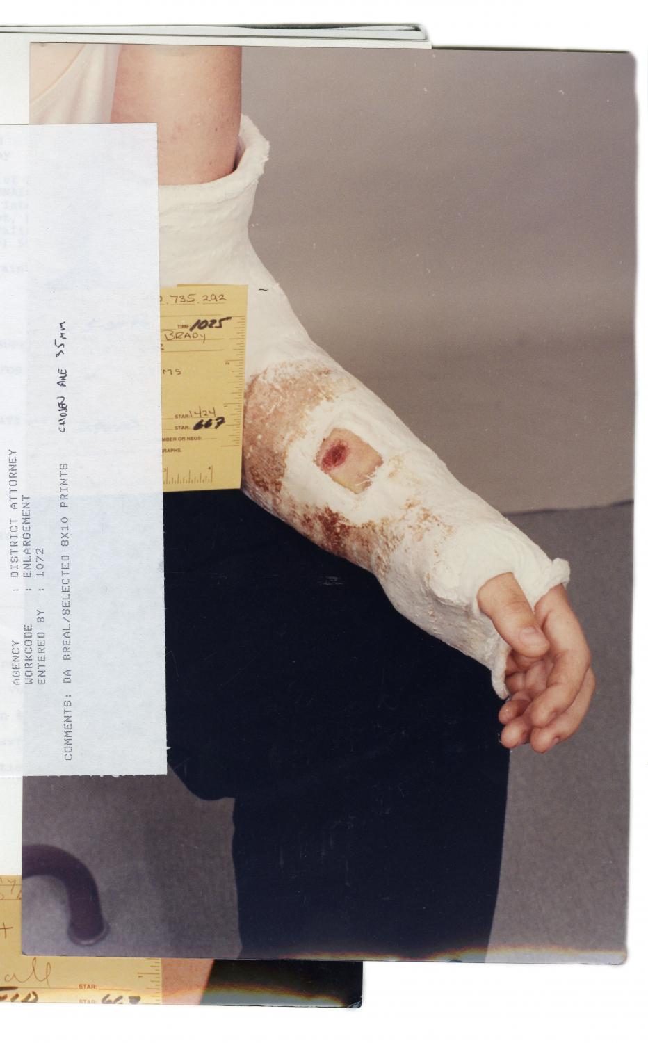 Police photo of Amy&#39;s arm after her attack, 1995