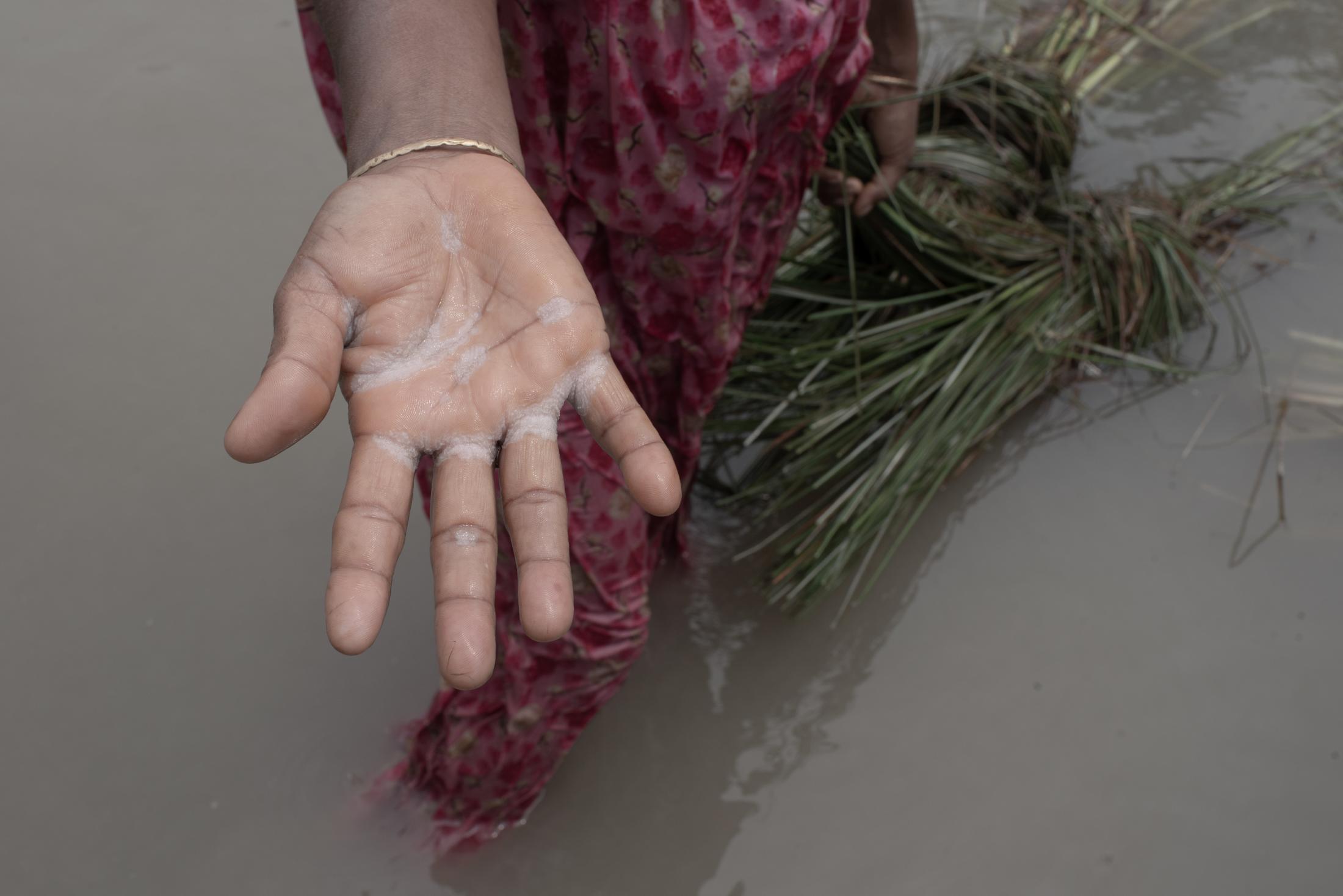 The Depth of Flood - A woman shows the palm of her hand which is infected by...