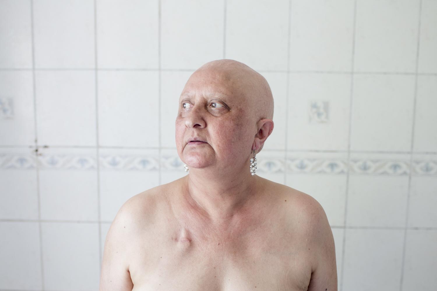 Triple negative -   After chemotherapy, Sonia waits for her breast...