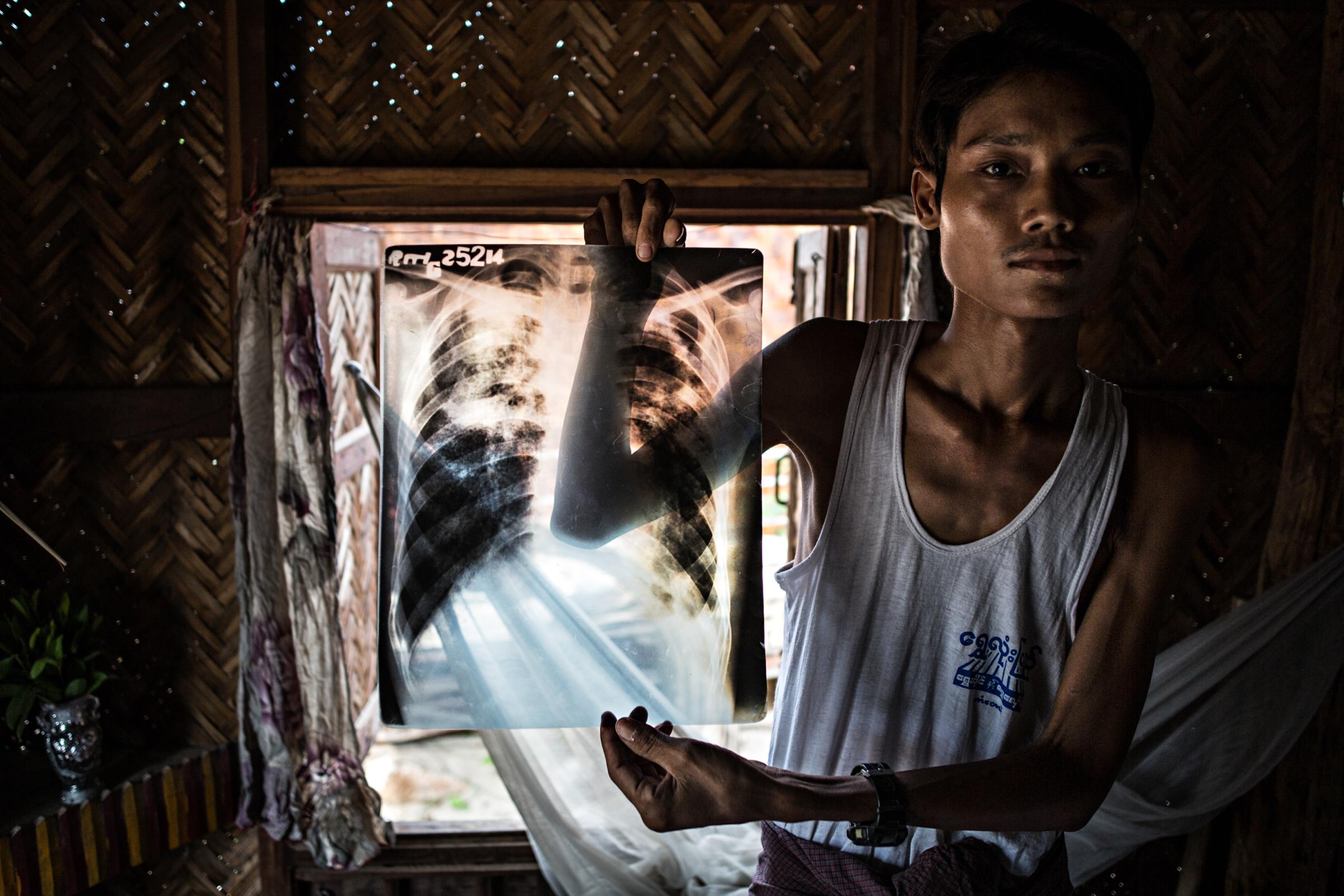 NGO - Ko Maw Gyi, a former miner, holds up his x-ray to show...